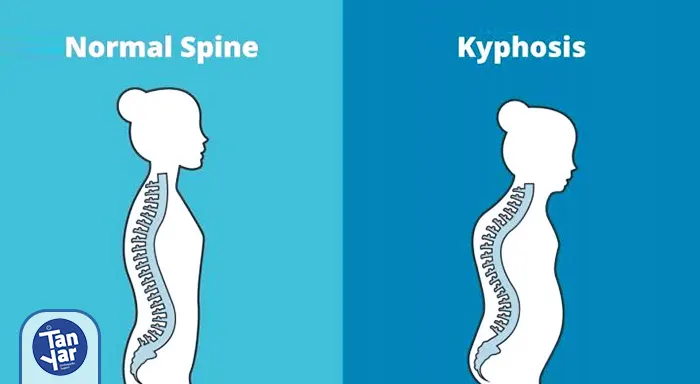 حالت صحیح قوز نکردن