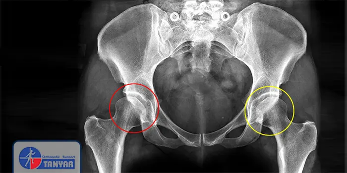 دیسپلازی مفصل ران در نوزادان