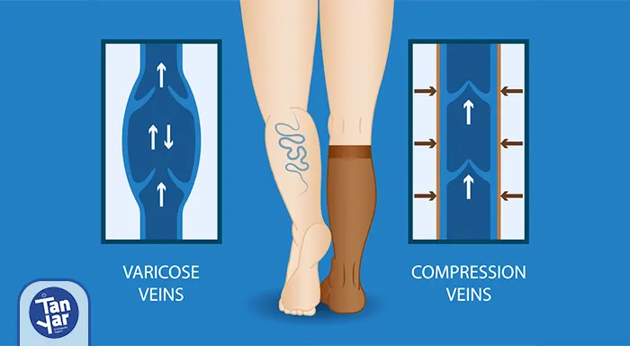 عملکرد جوراب واریس