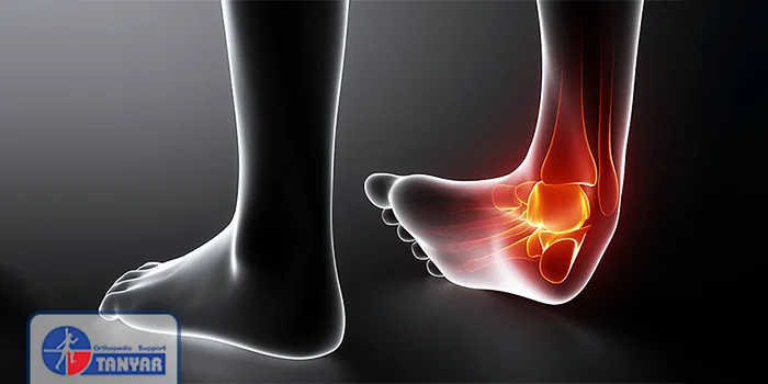 پیچ خوردن مچ پا