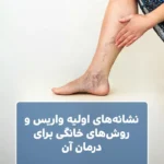 نشانه‌های اولیه واریس و روش‌های خانگی برای درمان آن