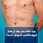 چرا شکم بند، بعد از عمل لیپوساکشن ضروری است؟
