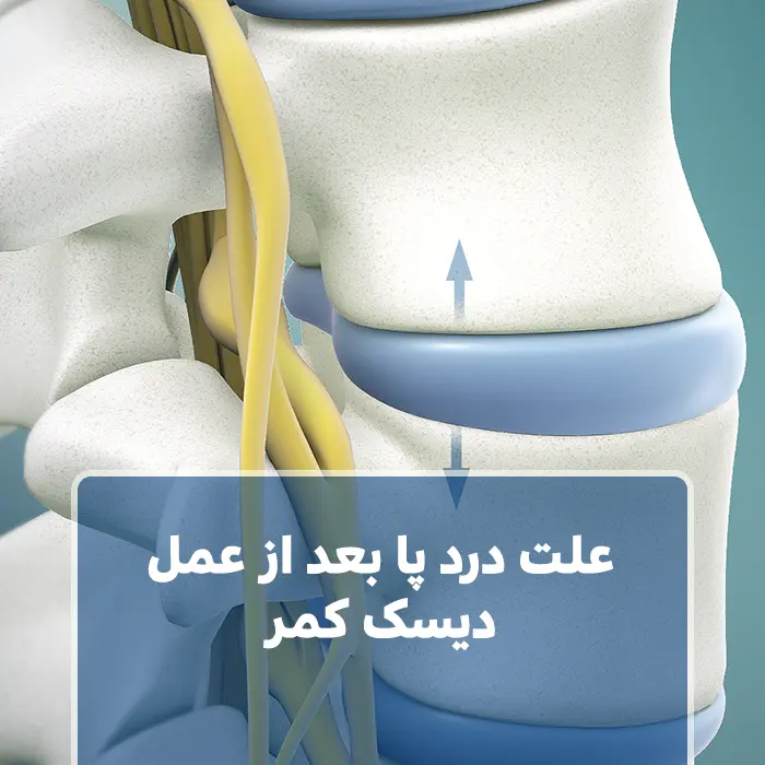 علت درد پا بعد از عمل دیسک کمر